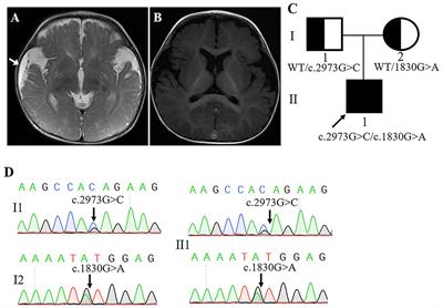 Case Report: A Novel Compound Heterozygous Mutation of the FRMD4A Gene Identified in a Chinese Family With Global Developmental Delay, Intellectual Disability, and Ataxia